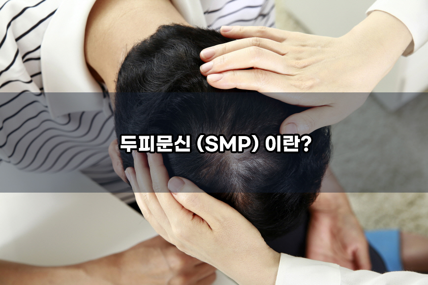 두피 문신 (smp) 장점과 부작용 가격 정보